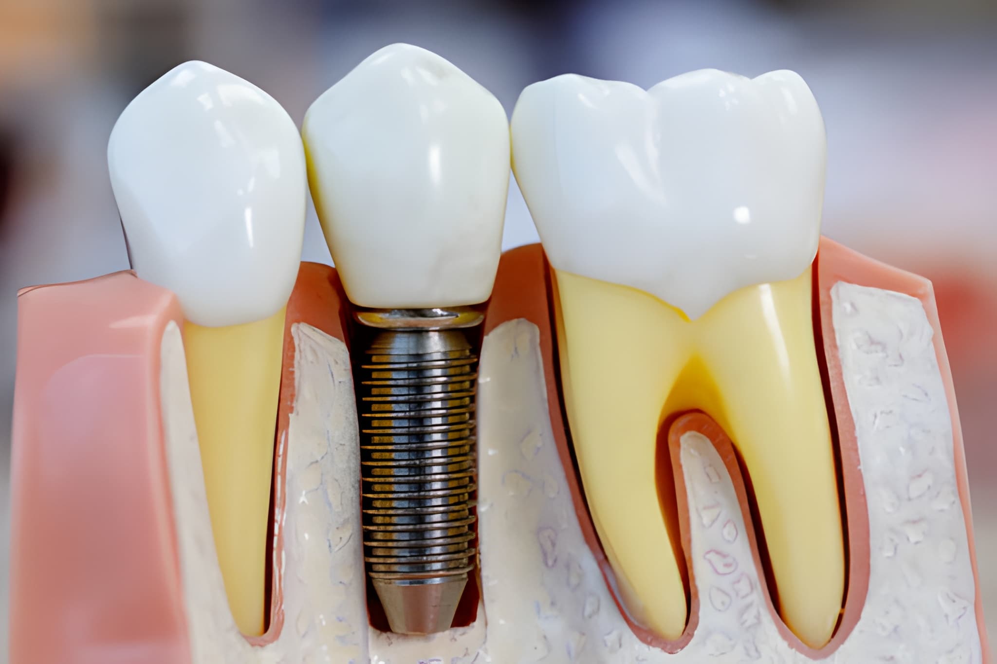 Hip replacement treatment