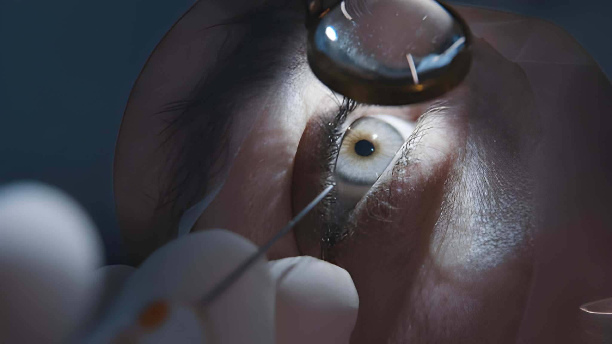 Cataract Surgery