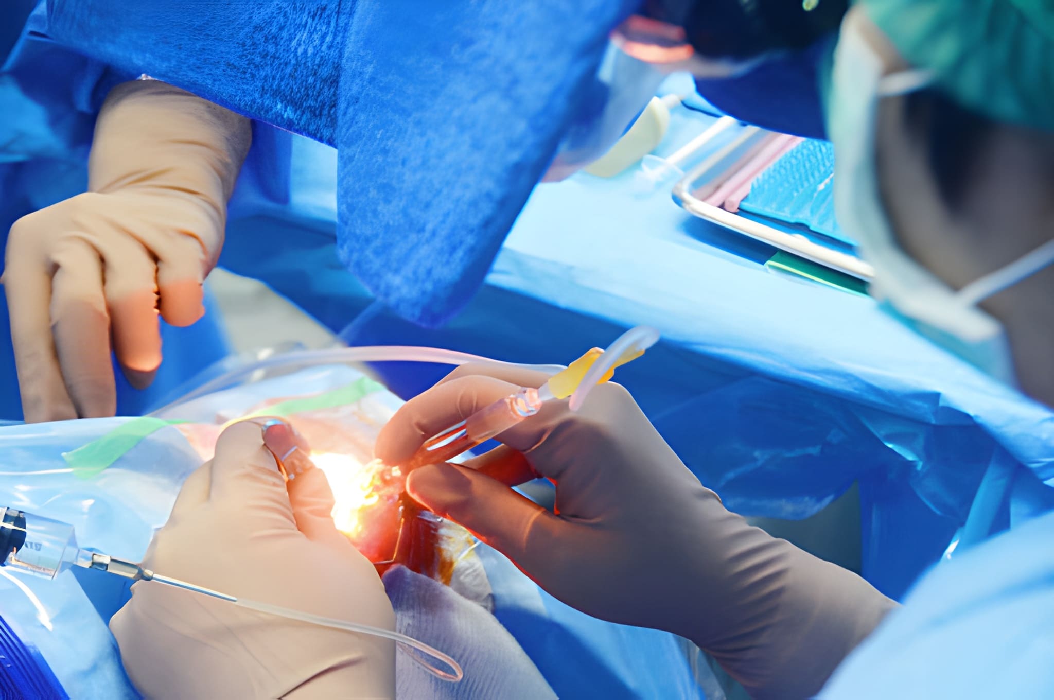 LASIK Surgery
